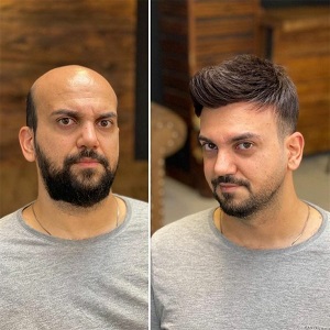 hair patch fixing services in kolkata (2)