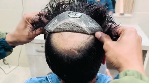 hair patch fixing services in kolkata
