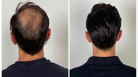 hair weaving service in Kolkata