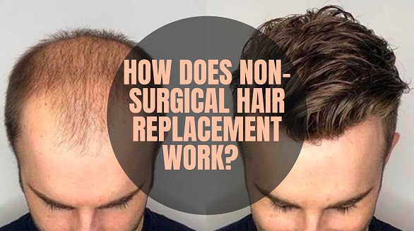 non surgical hair replacement service in kolkata